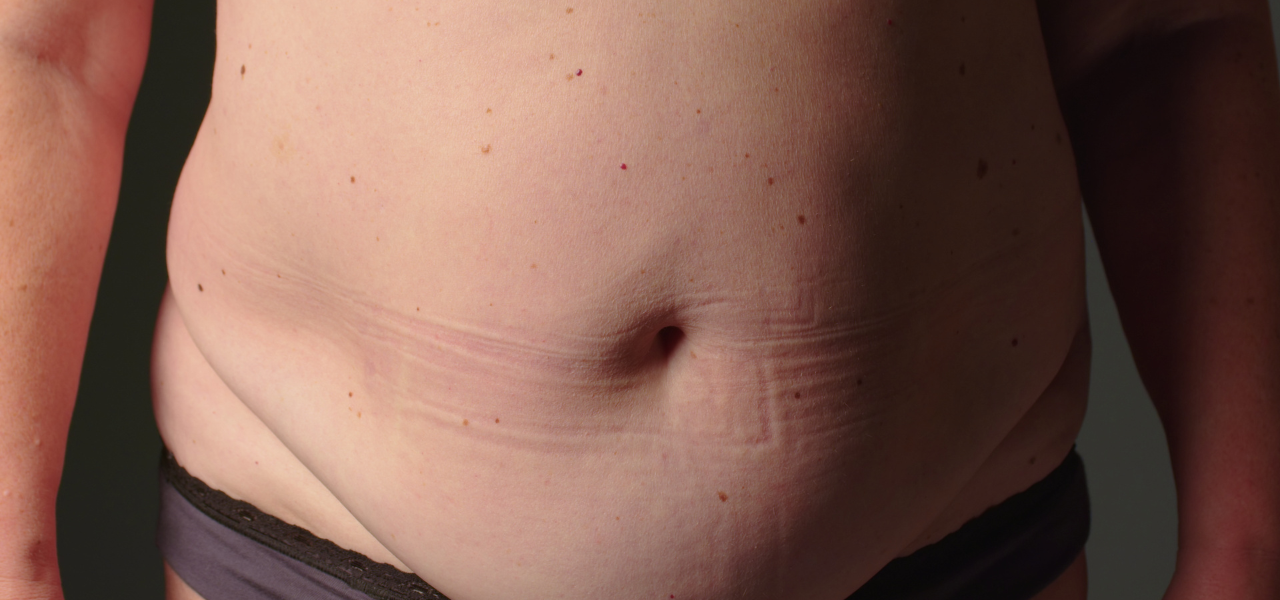 صورة واقعية تعبر عن التخطيط والالتزام بنمط حياة صحي للتخلص من البطن السفلي وتقليل دهون أسفل البطن بطريقة تدريجية وآمنة.